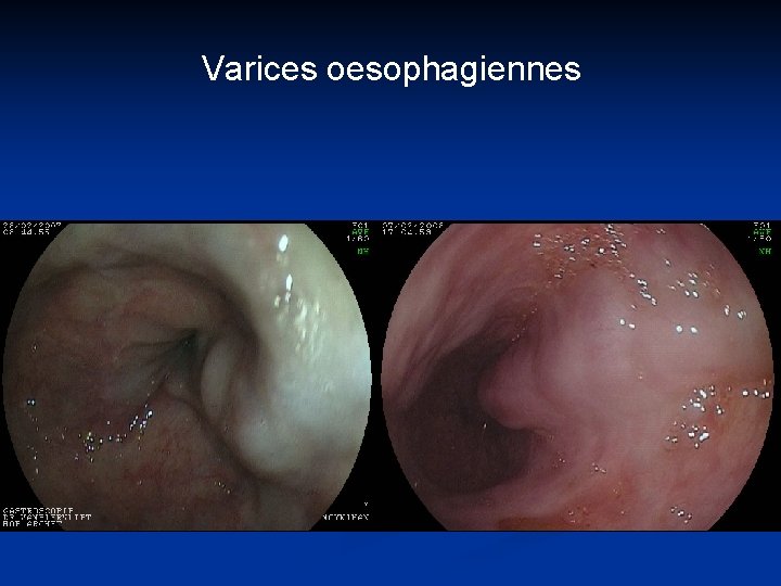 Varices oesophagiennes 