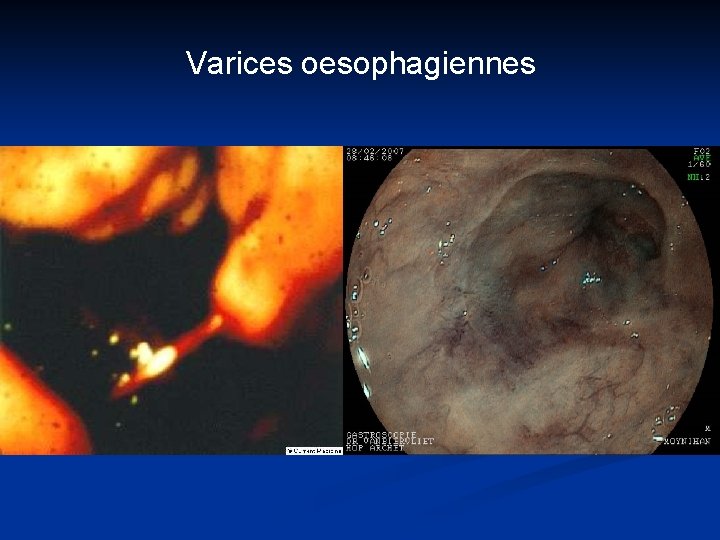 Varices oesophagiennes 