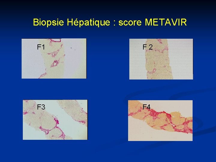 Biopsie Hépatique : score METAVIR F 1 F 2 F 3 F 4 