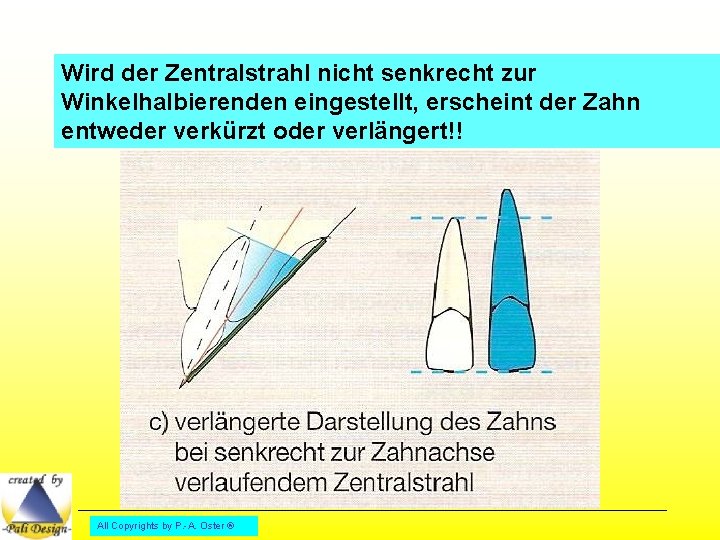 Wird der Zentralstrahl nicht senkrecht zur Winkelhalbierenden eingestellt, erscheint der Zahn entweder verkürzt oder