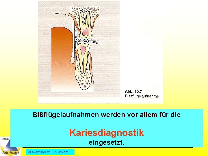 Bißflügelaufnahmen werden vor allem für die Kariesdiagnostik eingesetzt. All Copyrights by P. -A. Oster