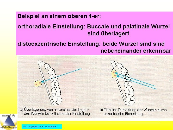 Beispiel an einem oberen 4 -er: orthoradiale Einstellung: Buccale und palatinale Wurzel sind überlagert