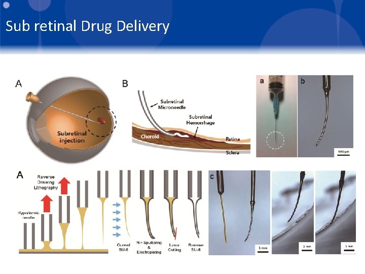 Sub retinal Drug Delivery 