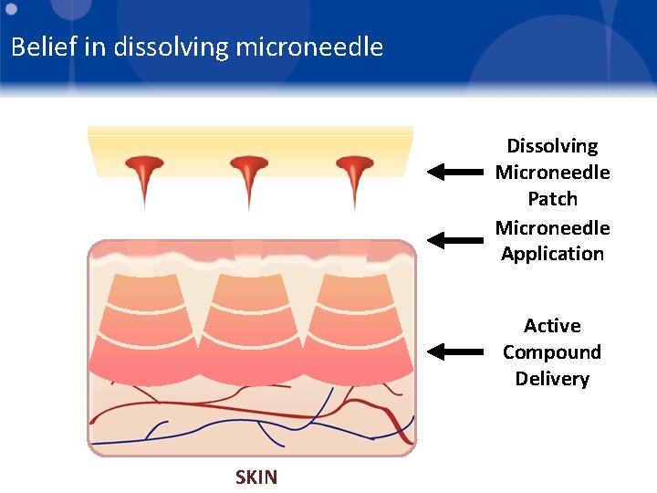 Belief in dissolving microneedle Dissolving Microneedle Patch Microneedle Application Active Compound Delivery SKIN 