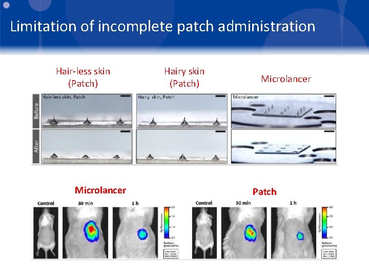 Limitation of incomplete patch administration Hair-less skin (Patch) Microlancer Hairy skin (Patch) Microlancer Patch