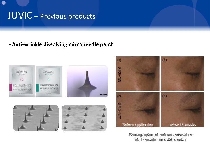 JUVIC – Previous products AA-DMN RR-DMN - Anti-wrinkle dissolving microneedle patch Before application After