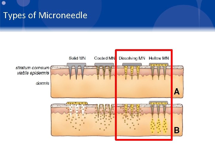 Types of Microneedle 