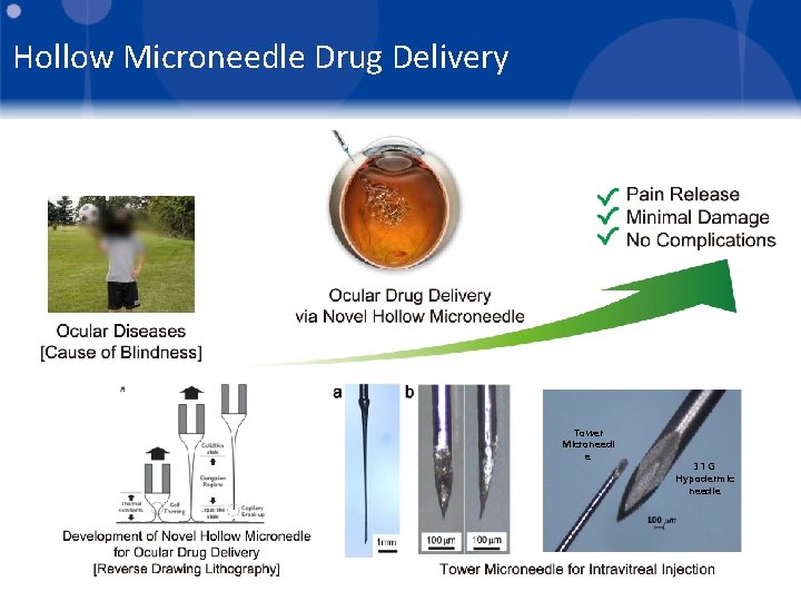 Hollow Microneedle Drug Delivery Tower Microneedl e 31 G Hypodermic needle 