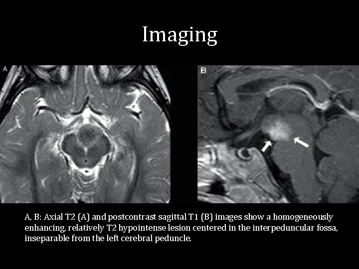 Imaging A, B: Axial T 2 (A) and postcontrast sagittal T 1 (B) images