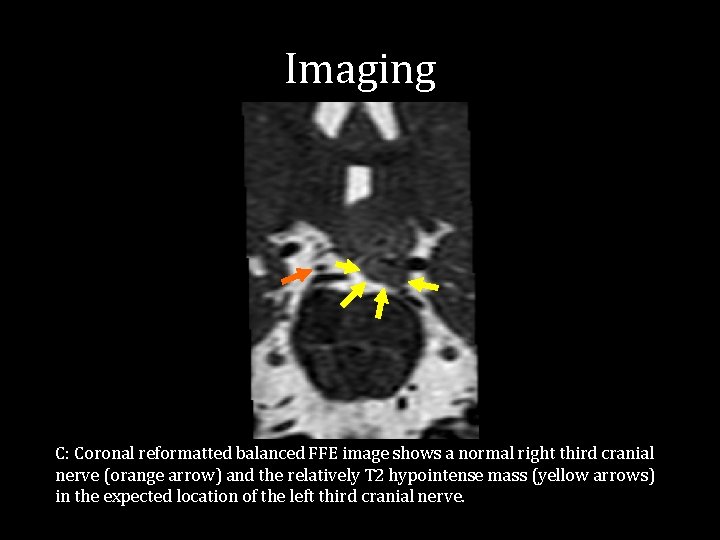 Imaging C: Coronal reformatted balanced FFE image shows a normal right third cranial nerve