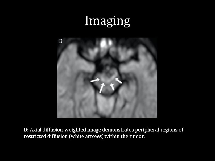 Imaging D: Axial diffusion-weighted image demonstrates peripheral regions of restricted diffusion (white arrows) within