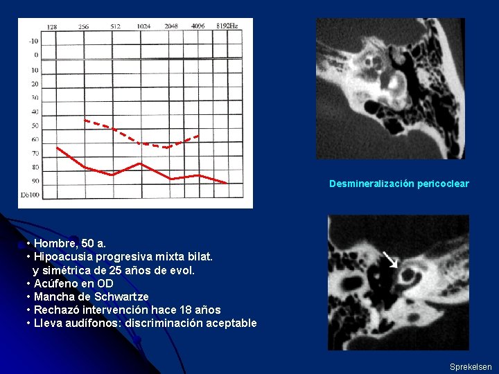 Desmineralización pericoclear • Hombre, 50 a. • Hipoacusia progresiva mixta bilat. y simétrica de