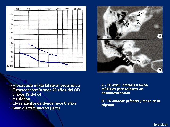  • Hipoacusia mixta bilateral progresiva • Estapedectomía hace 20 años del OD y