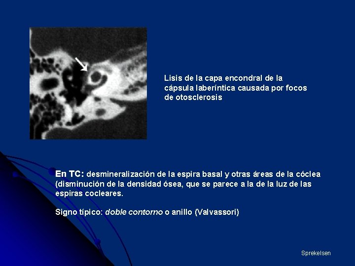 Lisis de la capa encondral de la cápsula laberíntica causada por focos de otosclerosis