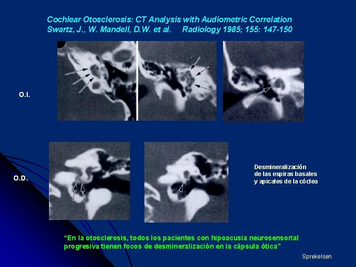 Cochlear Otosclerosis: CT Analysis with Audiometric Correlation Swartz, J. , W. Mandell, D. W.