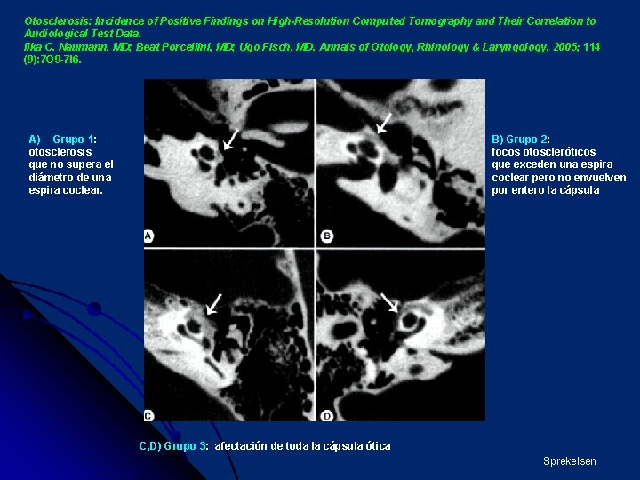 Otosclerosis: Incidence of Positive Findings on High-Resolution Computed Tomography and Their Correlation to Audiological