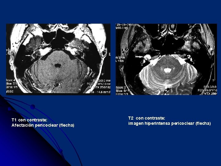 T 1 contraste: Afectación pericoclear (flecha) T 2 contraste: imagen hiperintensa pericoclear (flecha) 
