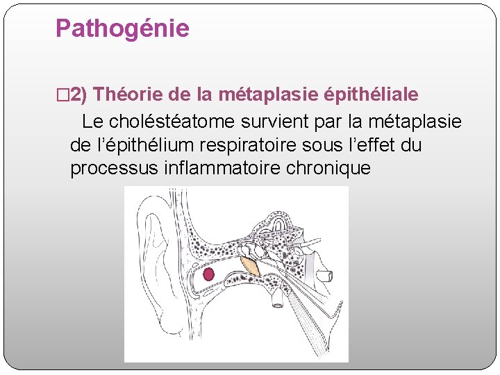 Pathogénie � 2) Théorie de la métaplasie épithéliale Le choléstéatome survient par la métaplasie