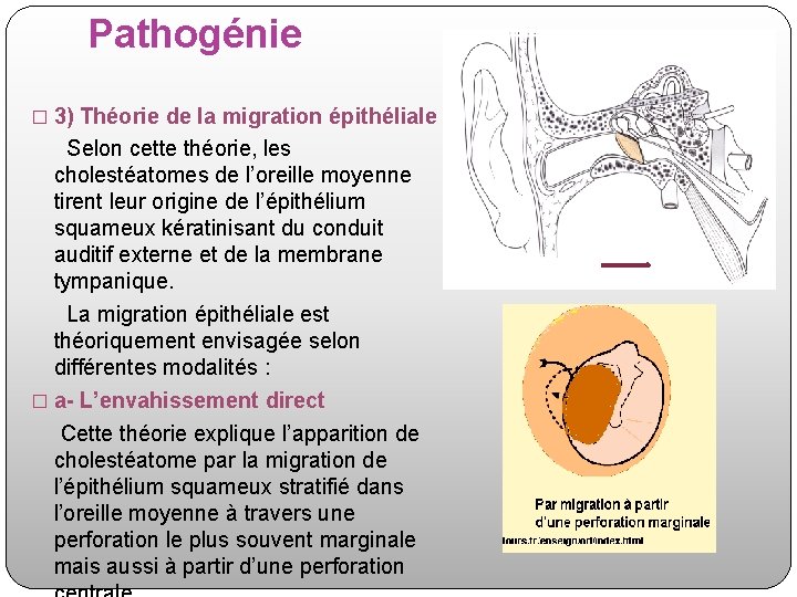 Pathogénie � 3) Théorie de la migration épithéliale Selon cette théorie, les cholestéatomes de