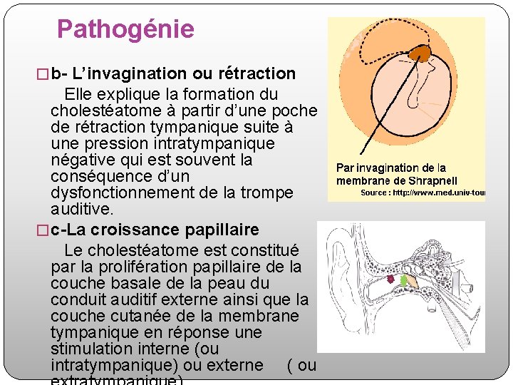 Pathogénie � b- L’invagination ou rétraction Elle explique la formation du cholestéatome à partir