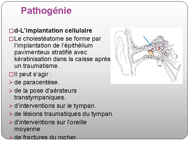 Pathogénie � d-L’implantation cellulaire � Le cholestéatome se forme par l’implantation de l’épithélium pavimenteux