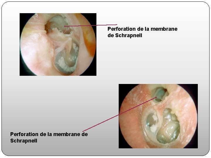 Perforation de la membrane de Schrapnell 