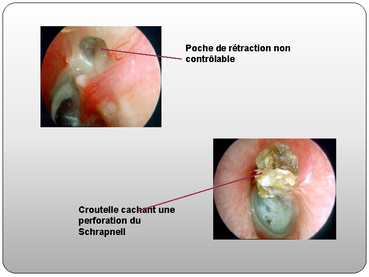 Poche de rétraction non contrôlable Croutelle cachant une perforation du Schrapnell 