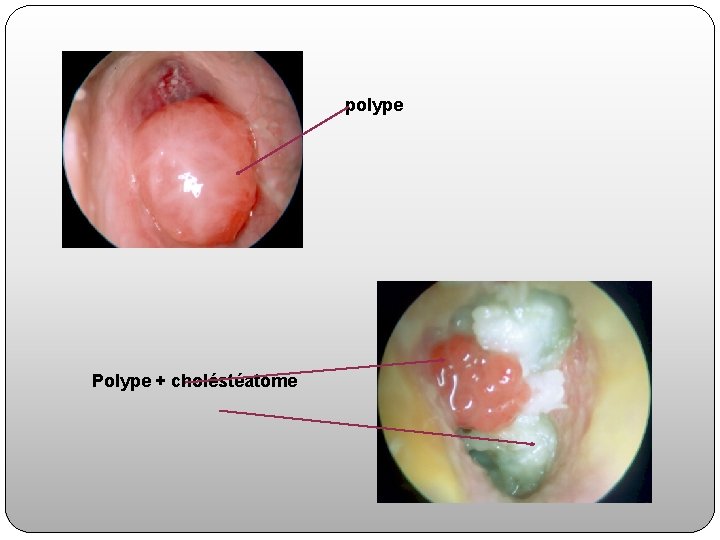 polype Polype + choléstéatome 