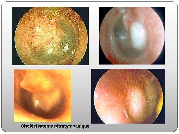 Choléstéatome rétrotympanique 