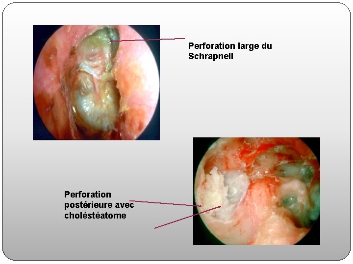 Perforation large du Schrapnell Perforation postérieure avec choléstéatome 