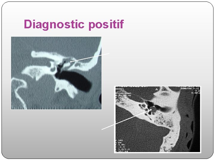 Diagnostic positif 