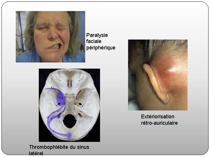 Paralysie faciale périphérique Extériorisation rétro-auriculaire Thrombophlébite du sinus latéral 