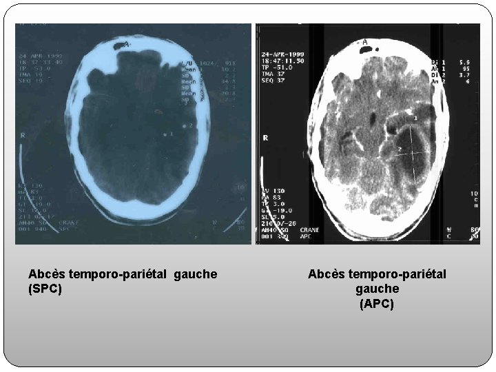 Abcès temporo-pariétal gauche (SPC) Abcès temporo-pariétal gauche (APC) 
