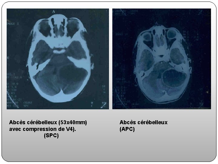 Abcès cérébelleux (53 x 40 mm) avec compression de V 4). (SPC) Abcès cérébelleux