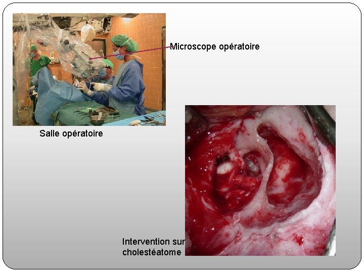 Microscope opératoire Salle opératoire Intervention sur cholestéatome 