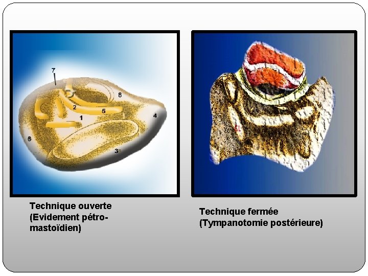 Technique ouverte (Evidement pétromastoïdien) Technique fermée (Tympanotomie postérieure) 