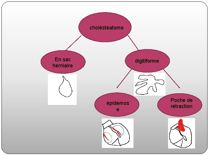 choléstéatome En sac herniaire digitiforme épidemos e Poche de rétraction 