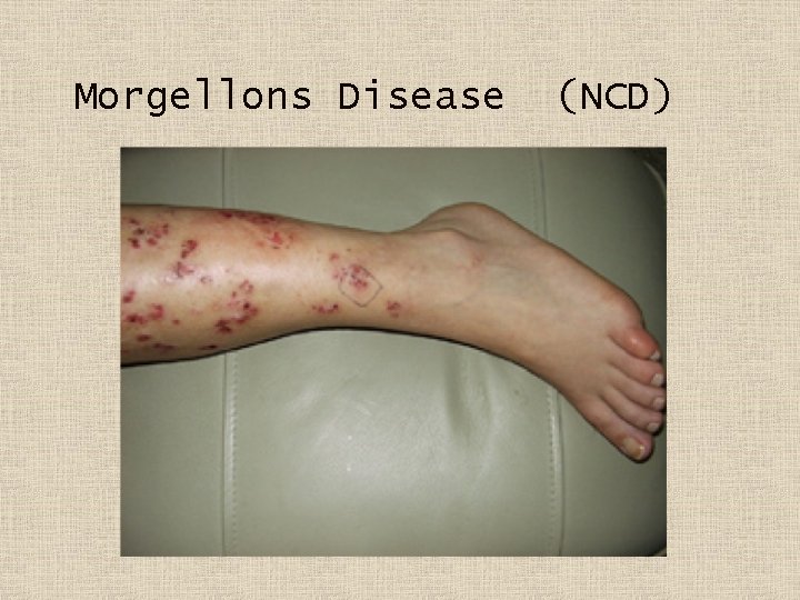Morgellons Disease (NCD) 
