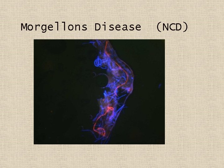 Morgellons Disease (NCD) 