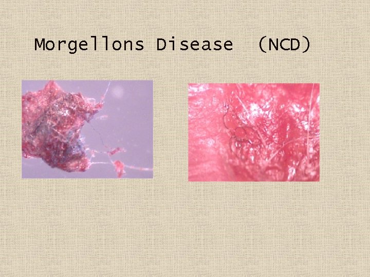 Morgellons Disease (NCD) 