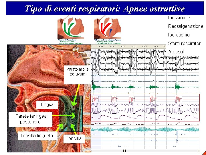 Tipo di eventi respiratori: Apnee ostruttive Ipossiemia Reossigenazione Ipercapnia Sforzi respiratori Arousal Palato molle