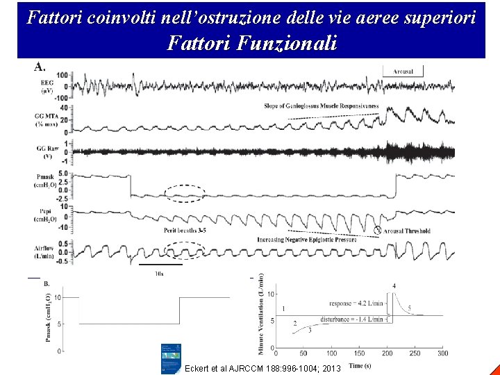 Fattori coinvolti nell’ostruzione delle vie aeree superiori Fattori Funzionali Eckert et al AJRCCM 188: