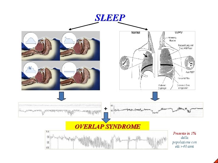 SLEEP + OVERLAP SYNDROME Presente in 1% della popolazione con età >40 anni 