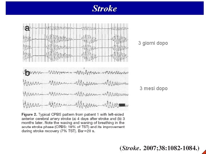 Stroke 3 giorni dopo 3 mesi dopo 