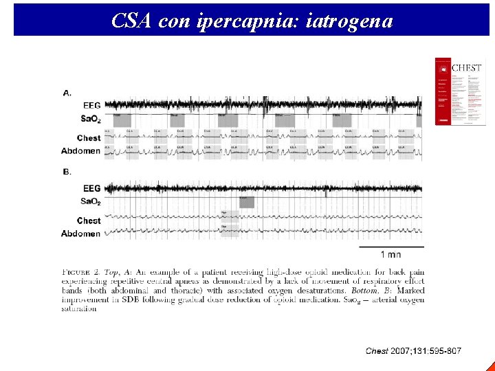 CSA con ipercapnia: iatrogena 