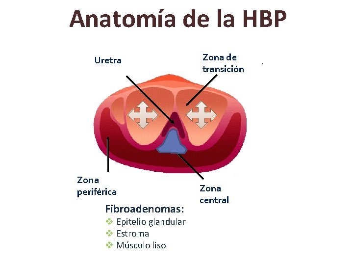 Anatomía de la HBP Uretra Zona periférica Fibroadenomas: v Epitelio glandular v Estroma v