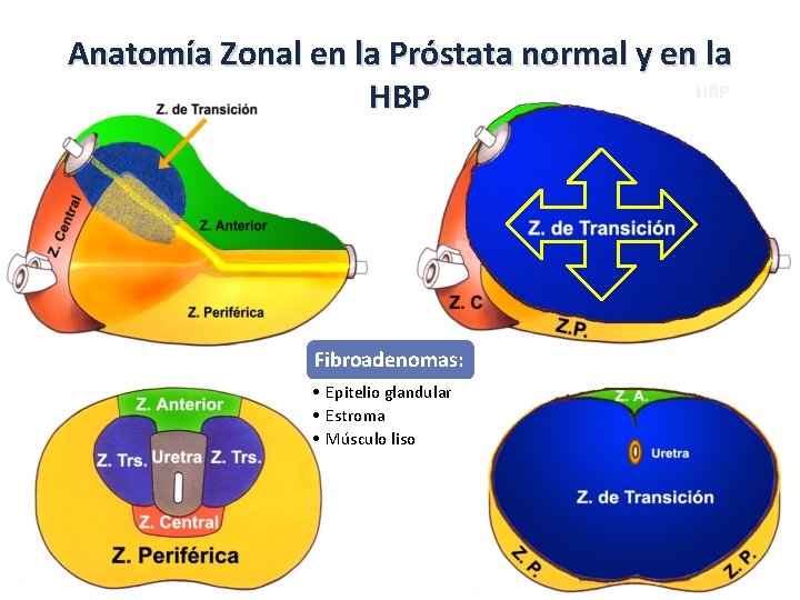 Anatomía Zonal en la Próstata normal y en la HBP Fibroadenomas: • Epitelio glandular