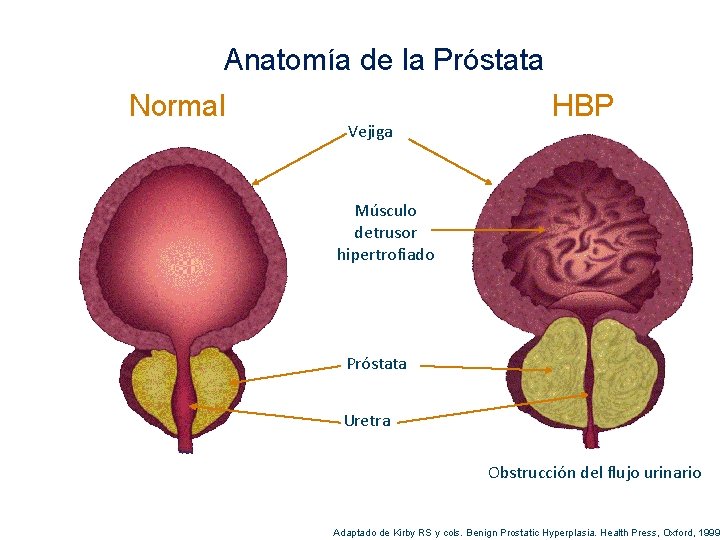 Anatomía de la Próstata Normal Vejiga HBP Músculo detrusor hipertrofiado Próstata Uretra Obstrucción del