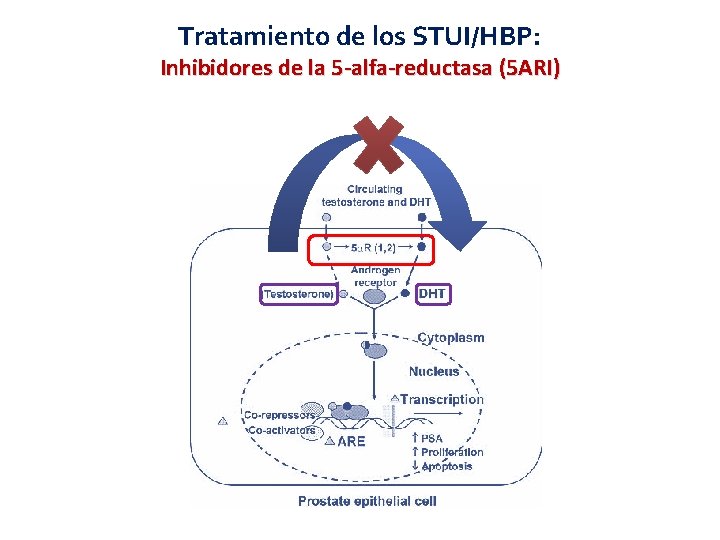 Tratamiento de los STUI/HBP: Inhibidores de la 5 -alfa-reductasa (5 ARI) 