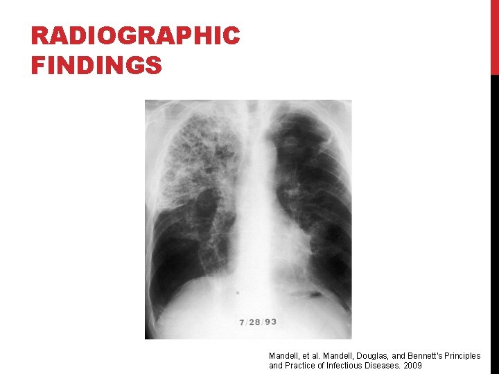 RADIOGRAPHIC FINDINGS Mandell, et al. Mandell, Douglas, and Bennett's Principles and Practice of Infectious